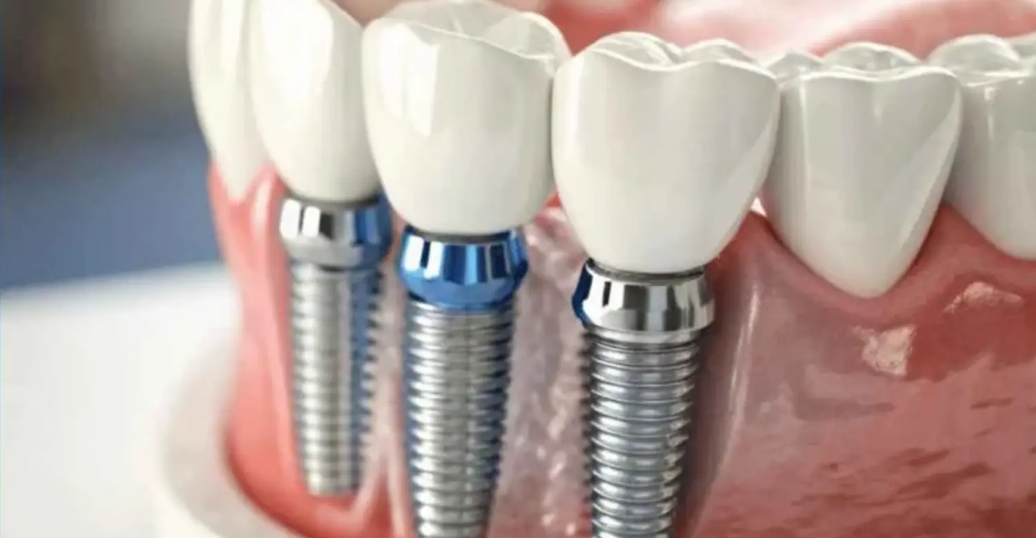 How long stay in Turkey for dental implants 2
